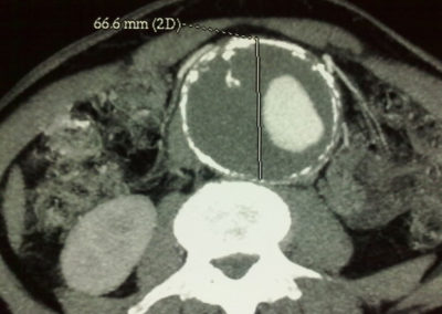 Corte Transversal Aneurisma Aorta Abdominal Cirugía Cardiovascular En Centro Cardiovascular Málaga
