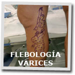 flebologia varices home