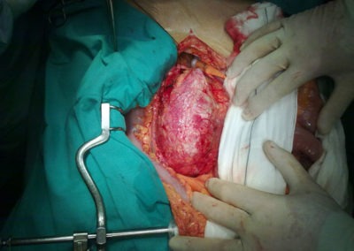 reparacion abierta aneurisma aorta abdominal Cirugía cardiovascular en Centro Cardiovascular Málaga